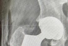 W Szpitalu Powiatowym im. PCK w Nisku przeprowadzono pionierski innowacyjny zabieg